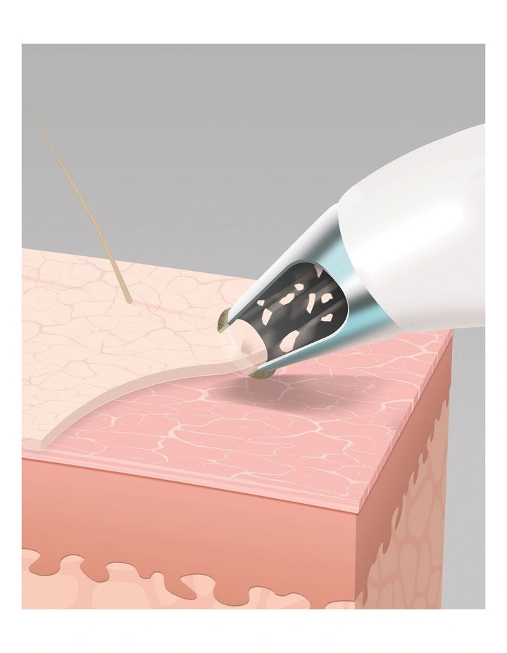 Best deal ๐คฉ Homedics Radiance Microdermabrasion With Cooling In White ๐ 8 Best deal ๐คฉ Homedics Radiance Microdermabrasion With Cooling In White ๐ - Image 6